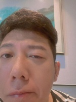 海泉右眼发炎眼皮又红又肿 在线向网友求消肿方法