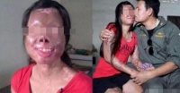 妙龄女子不幸被硫酸毁容，女子男友的做法，让人感动不已