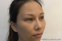 九院韦敏教授丨颧弓内推，温柔了脸型也温柔了生活