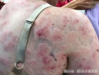 宝妈外出突遇特大冰雹，用身体保护孩子严重受伤，事后在网上道歉