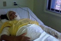 女子被严重烧伤，医生大胆尝新植入鱼皮，几个月后不淡定