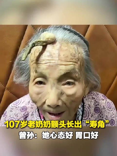 107岁奶奶额头长出罕见寿角