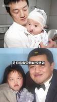 王菲二女儿经历四次手术成功矫正兔唇
