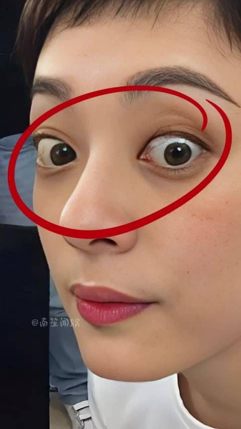 为何孙俪突然眼睛凸起？本以为是得了甲亢，真相曝光竟被骗了多年 李连杰