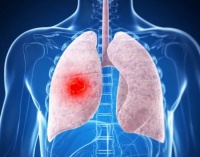 多种方法综合治疗 肺腺癌也可治愈