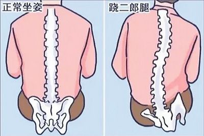 跷二郎腿导致脊柱不正常弯曲。